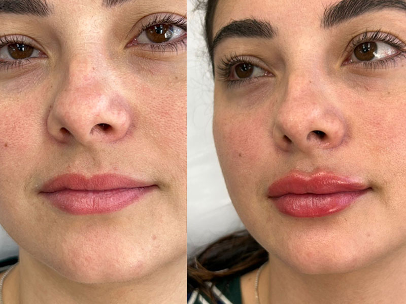Preenchimento labial: quando é indicado e como garantir naturalidade no resultado