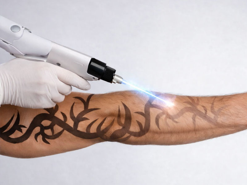 Remoção de tatuagem a laser: como funciona, quantas sessões são necessárias e o que esperar do processo
