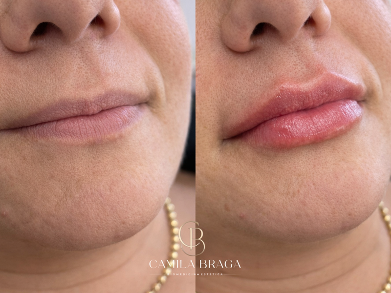 Preenchimento labial