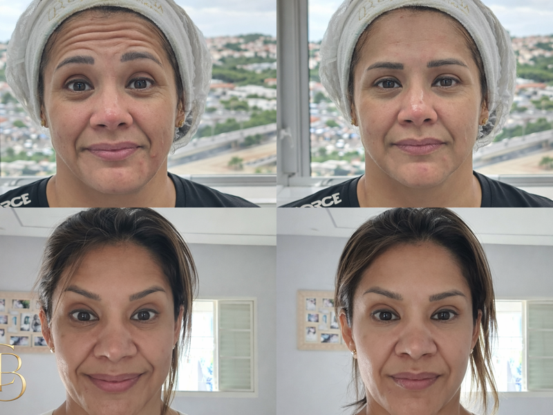 Toxina Botulínica - BOTOX